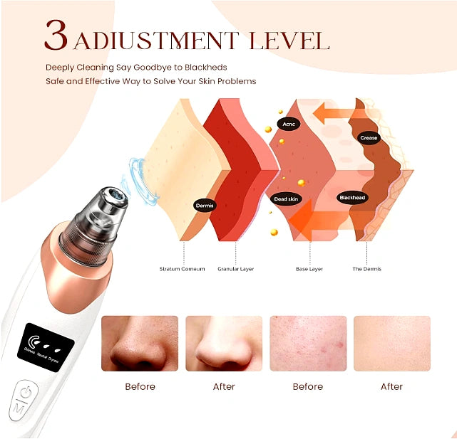 Blackhead Remover for deep pore cleansing 5 in 1